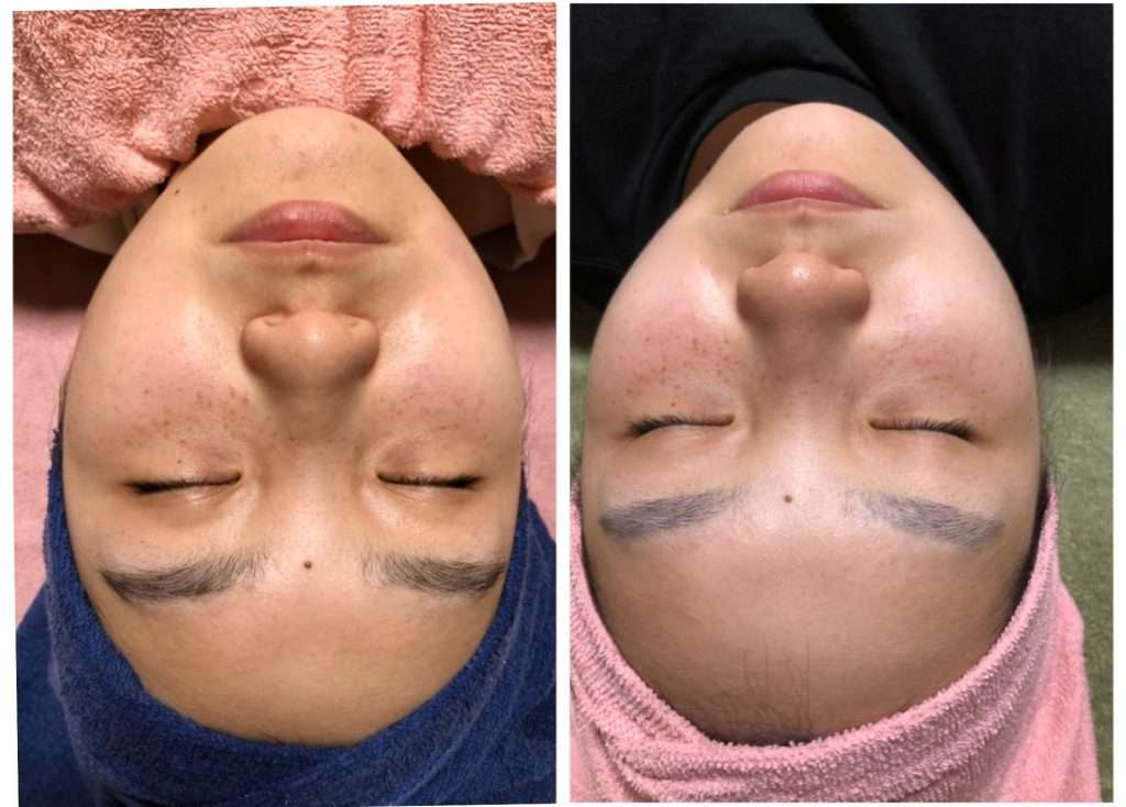 究極の肌再生メニュー シリカニードルトリートメント お知らせ Kokoro 田辺市のビューティー 和歌山県エリアガイド Kiilife キーライフ